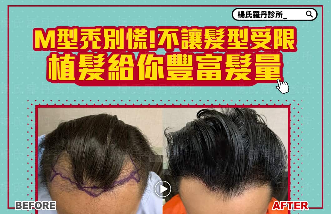 【植髮】M型禿別慌!不讓髮型受限，植髮給你豐富髮量
