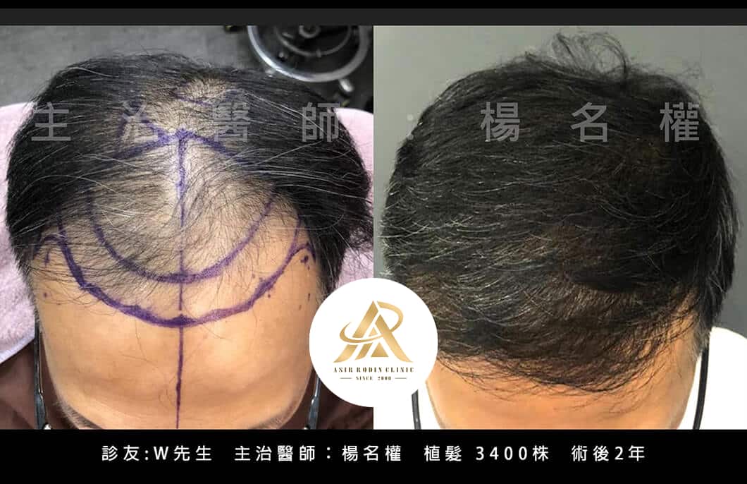 【植髮】擺脫禿頭、追求濃密茂髮，我們助您一臂之力！