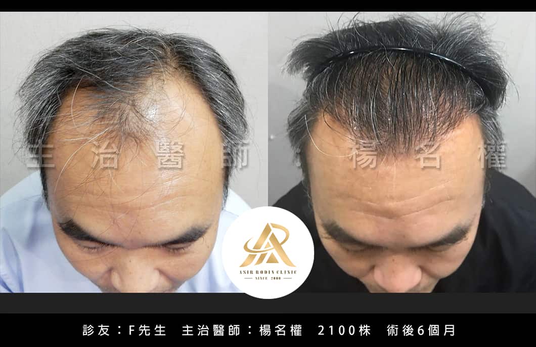 【植髮】診友自信的笑容是我們的動力！