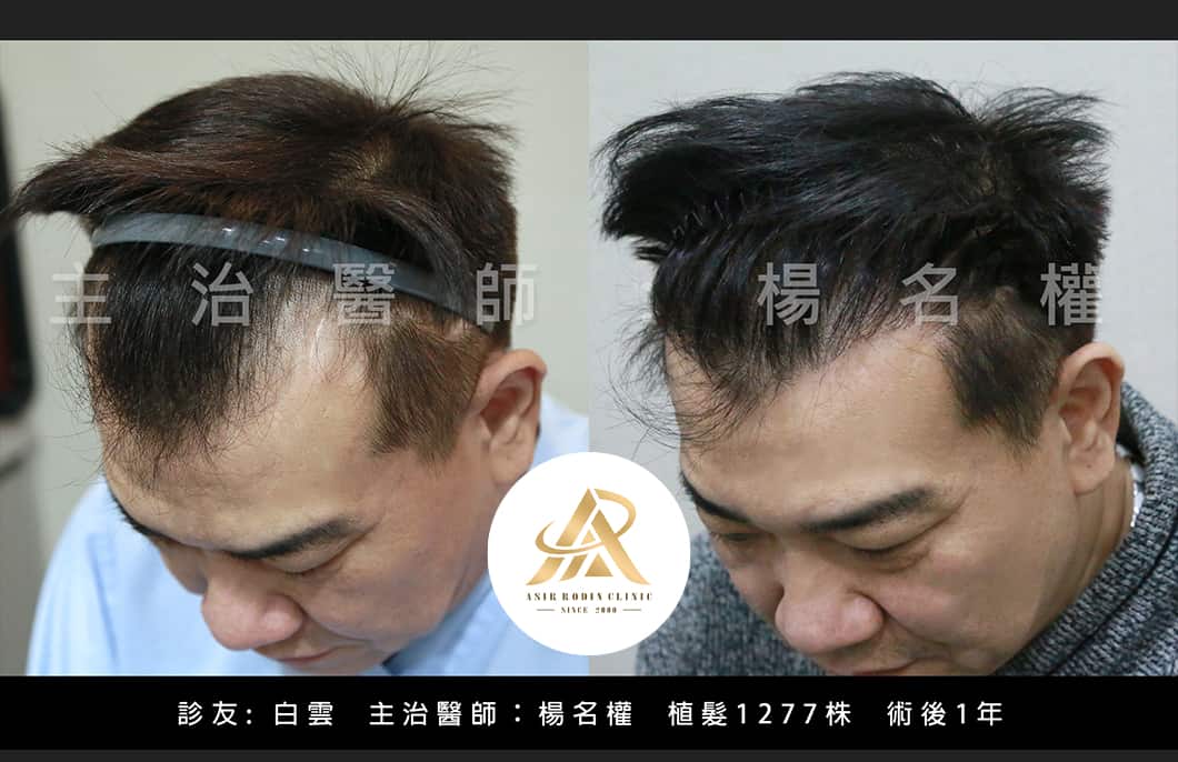 【植髮】楊名權醫師：白雲大哥的麥當勞標誌不見了！