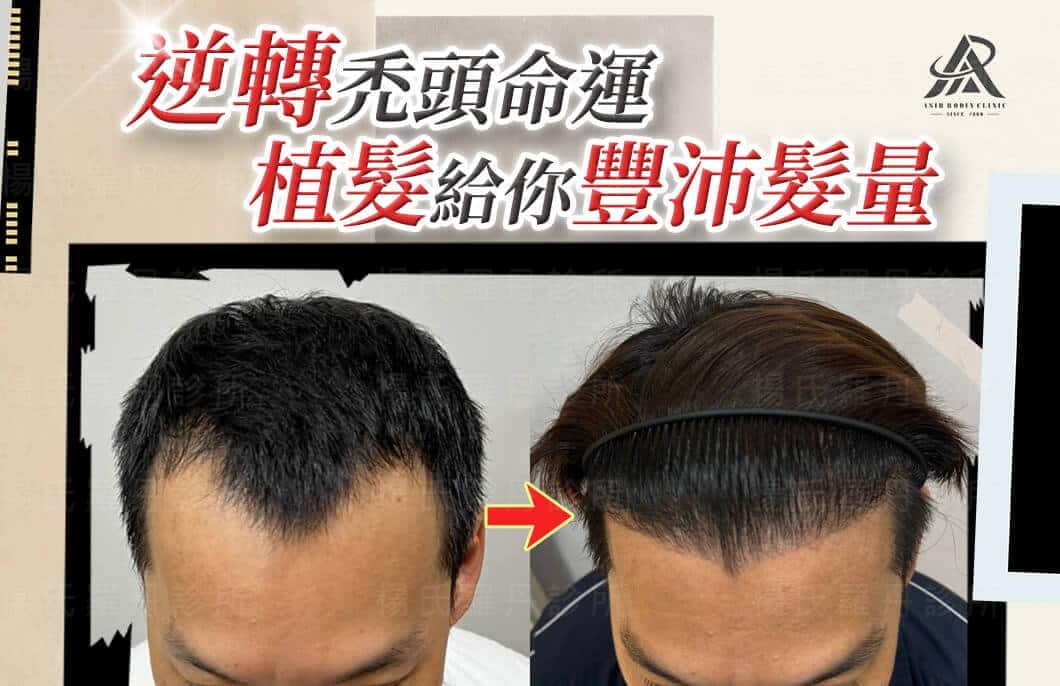 【植髮】逆轉禿頭命運，植髮給你豐沛髮量輕鬆展現自信