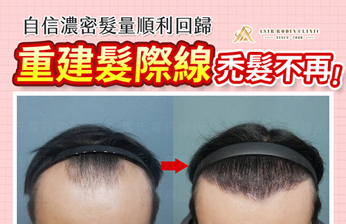 【植髮】禿髮不再，重建髮際線，自信濃密髮量順利回歸