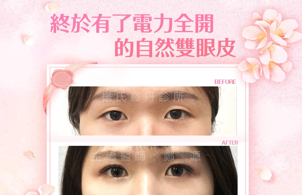 【雙眼皮】終於有了電力全開的自然雙眼皮！