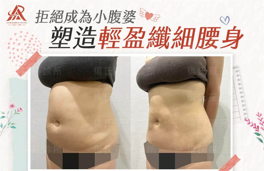 【雷射減脂】拒絕成為小腹婆，塑造理想的輕盈纖細腰身