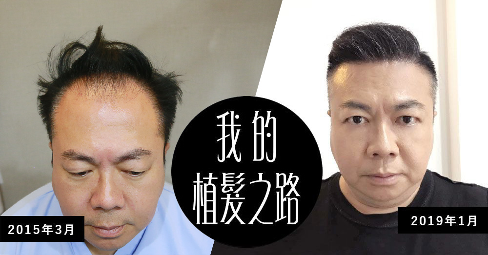 董哥董至成救禿頭  找上羅丹診所ARTAS植髮幫忙！