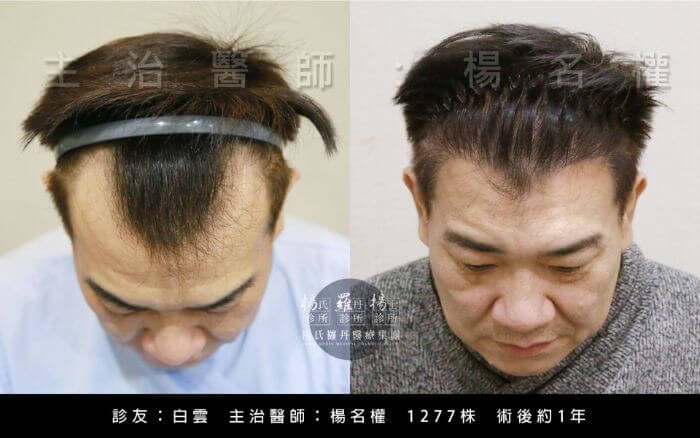 【植髮案例介紹】12位明星、素人植髮背景與術後心得統整