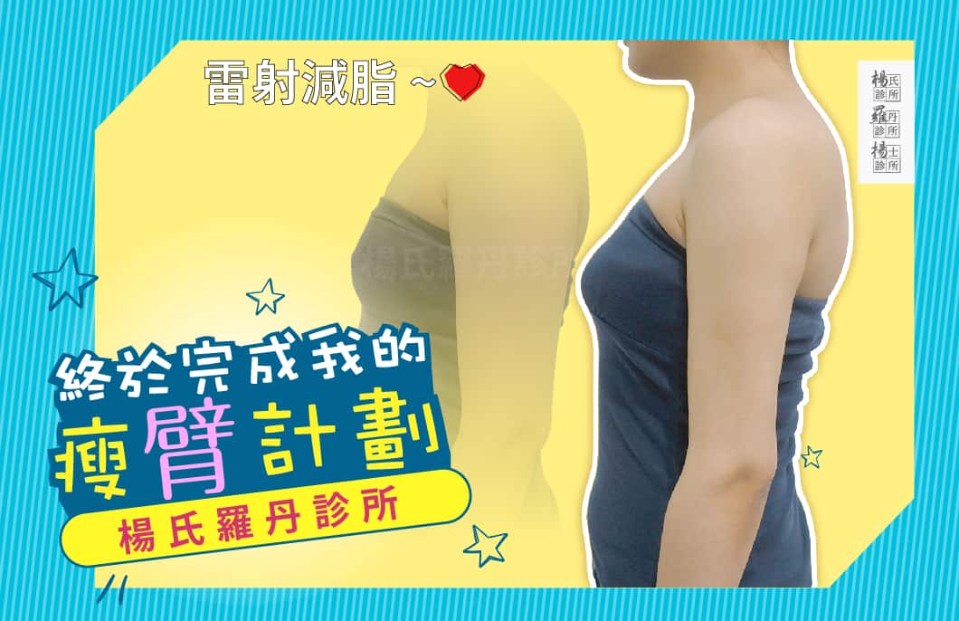 【雷射減脂】終於完成我的瘦臂計畫！
