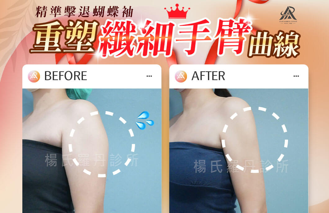 【雷射減脂】精準擊退蝴蝶袖，重塑纖細緊緻手臂曲線！