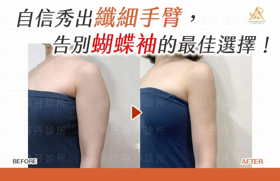 【雷射減脂】自信秀出纖細手臂，告別蝴蝶袖的最佳選擇