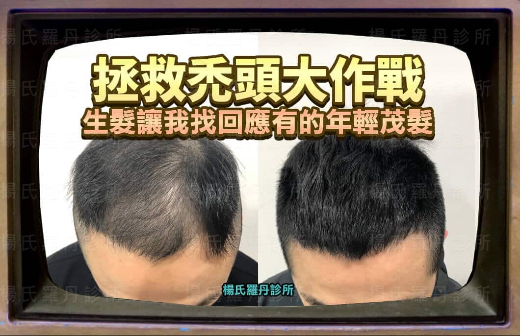 【複合式生髮】拯救禿頭大作戰 生髮讓我找回應有的年輕茂髮