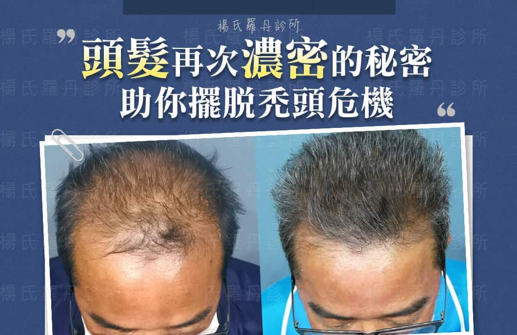 【複合式生髮】頭髮再次濃密的秘密，助你擺脫禿頭危機
