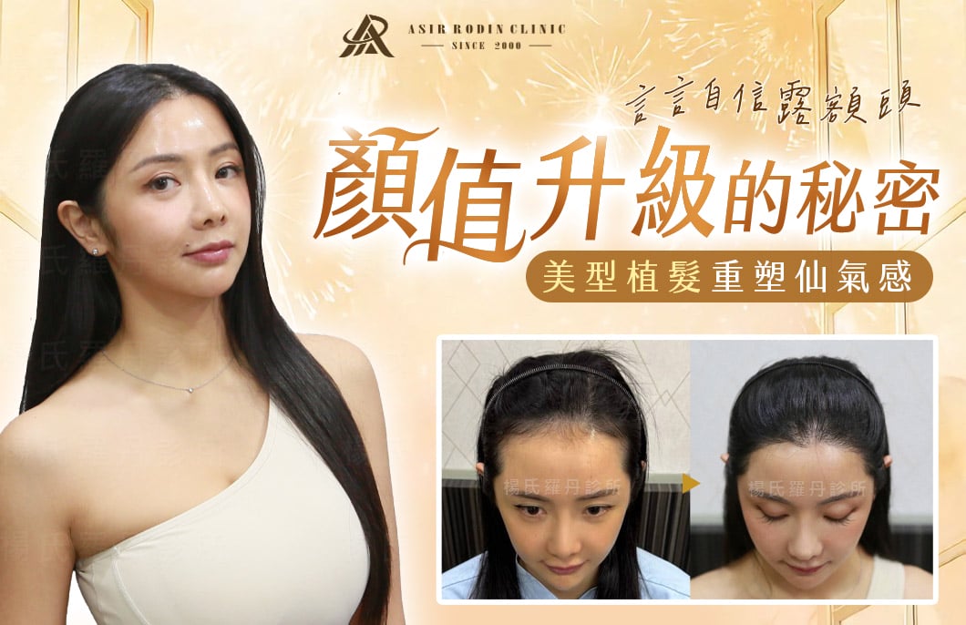 【植髮】顏值升級的秘密！美型植髮重塑仙氣感，言言自信露額頭