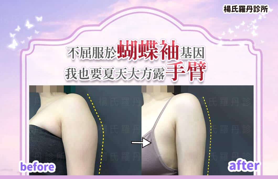 【雷射減脂】不屈服於蝴蝶袖基因，我也要夏天大方露手臂