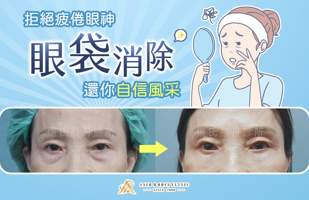 【眼袋淚溝】拒絕疲倦眼神，眼袋消除手術還你自信風采