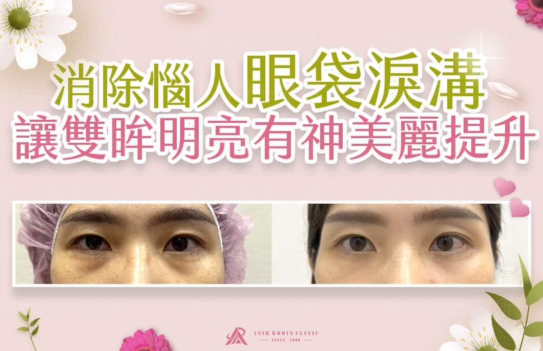 【眼袋淚溝】消除惱人眼袋淚溝，讓雙眸明亮有神美麗提升