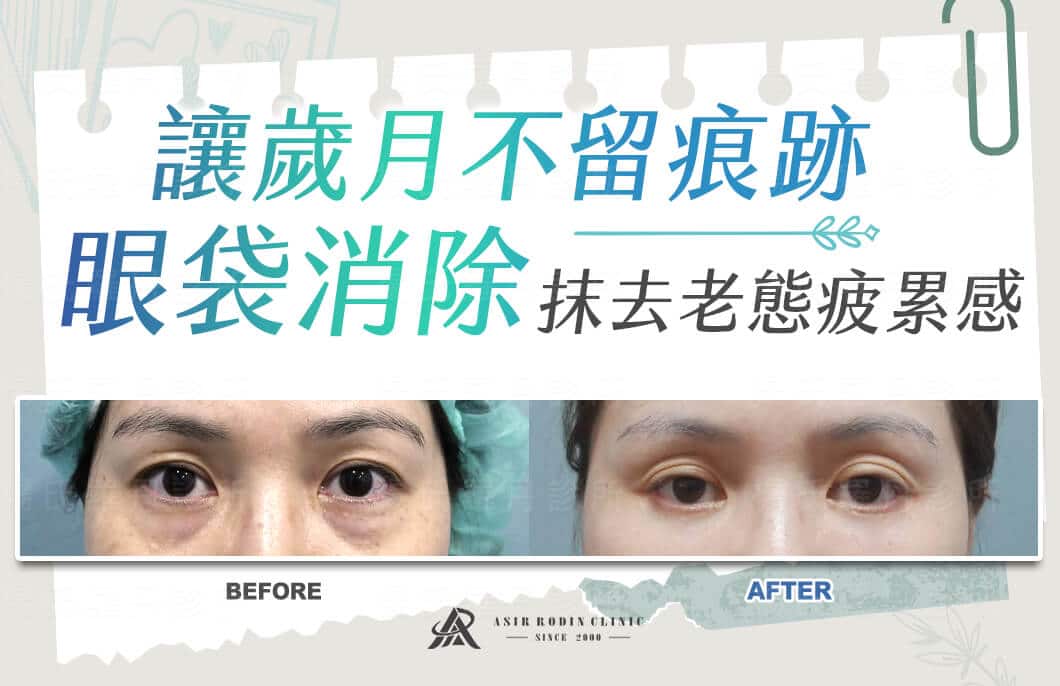 【眼袋淚溝】讓歲月不留痕跡，眼袋消除抹去老態疲累感