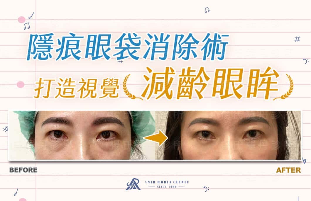 【眼袋淚溝】隱痕眼袋消除術，打造視覺減齡有神眼眸！