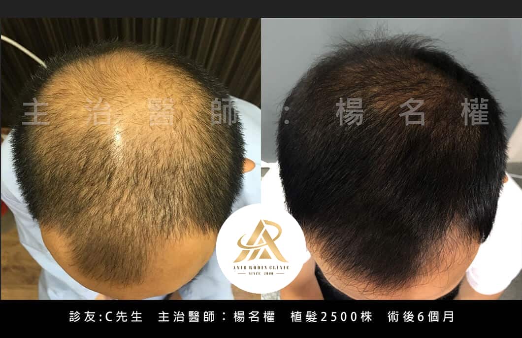 【植髮】掉髮不再、禿頭不見，來楊氏羅丹植髮後桃花跟著來
