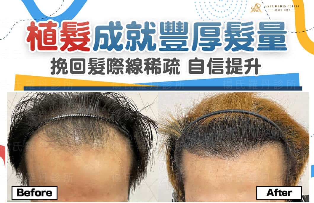 【植髮】植髮成就豐厚髮量，挽回髮際線稀疏助你自信提升