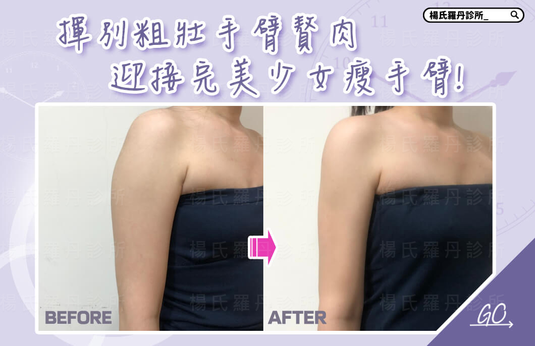 【雷射減脂】揮別粗壯手臂贅肉，迎接完美少女瘦手臂!