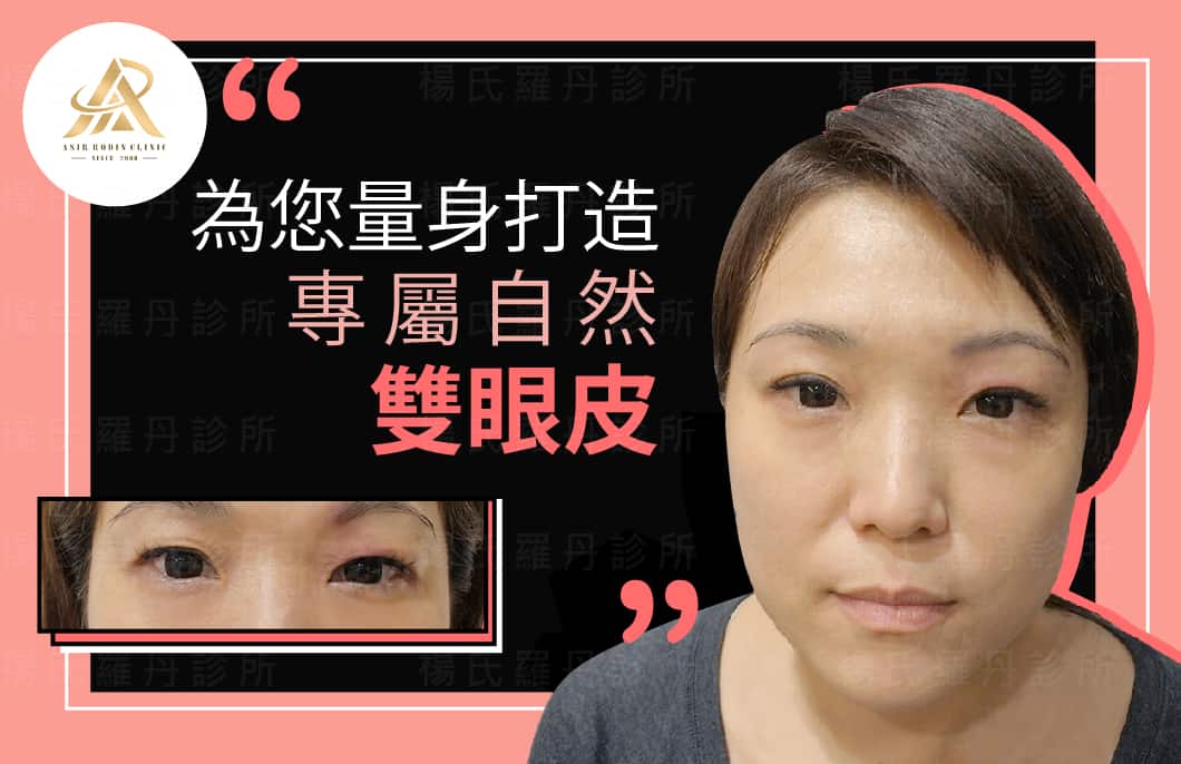 【雙眼皮】為你量身打造 自然雙眼皮 !