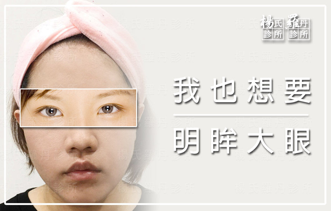 【訂書機雙眼皮】我也想要明星般的大眼！