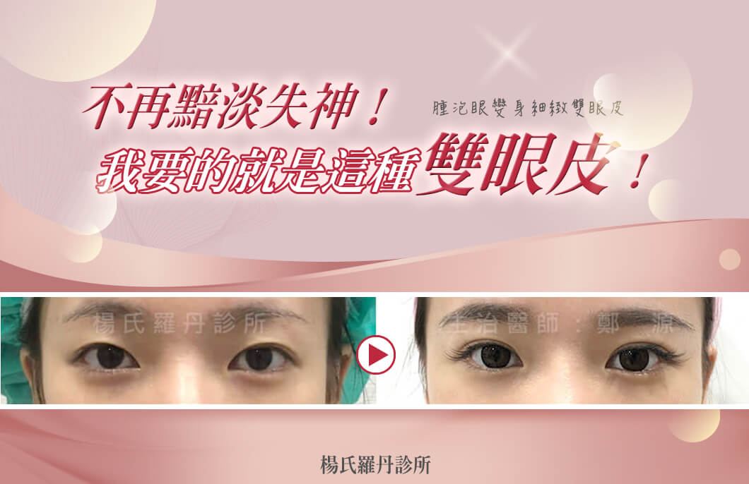 【雙眼皮】不再黯淡失神！我要的就是這種釘書機雙眼皮！
