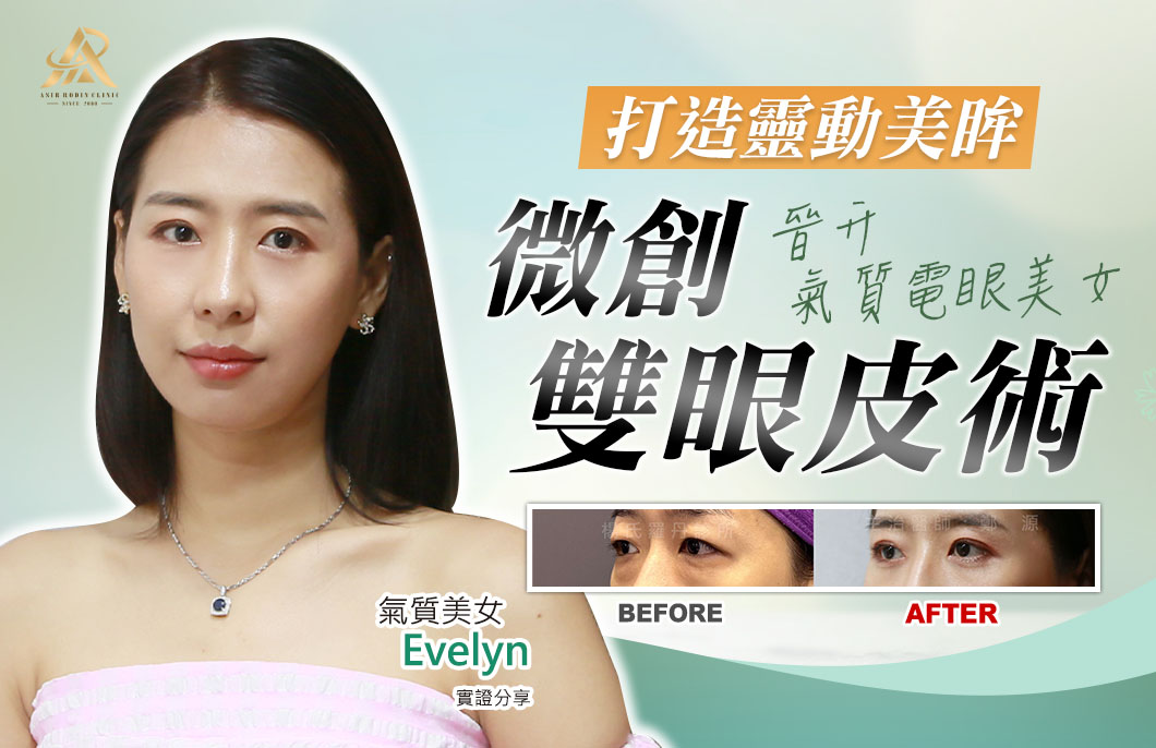 【雙眼皮】打造靈動美眸，微創雙眼皮術晉升氣質電眼美女