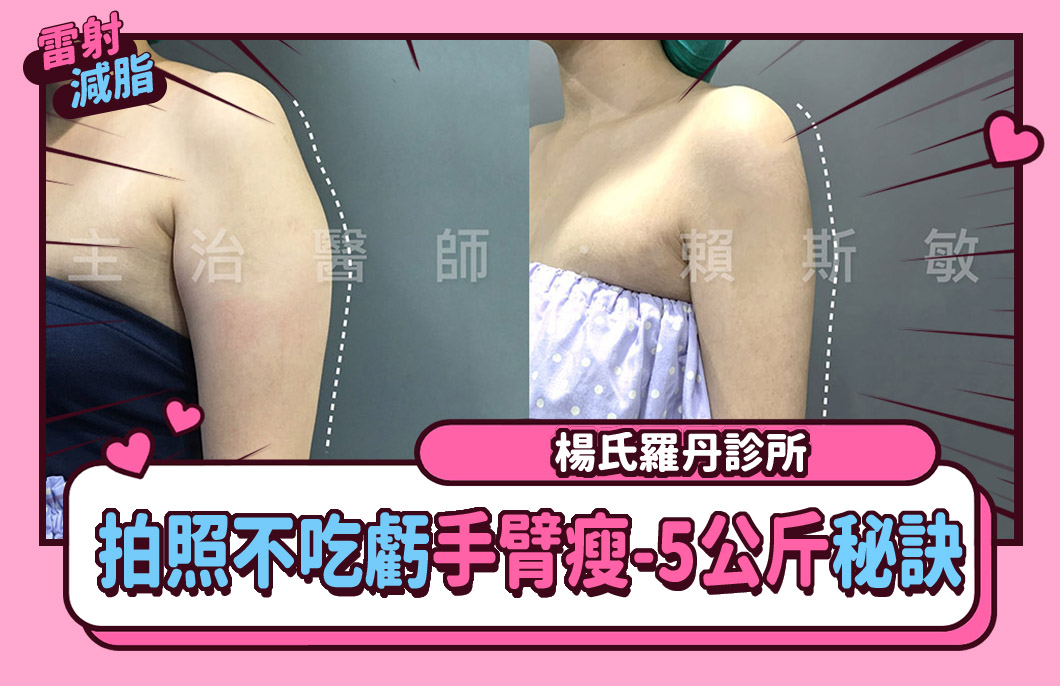【雷射減脂】拍照不吃虧，手臂瘦視覺即減5公斤