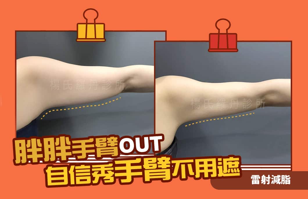 【雷射減脂】胖胖手臂OUT！雷射減脂自信秀手臂不用遮