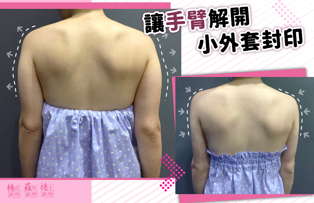 【雷射減脂】讓手臂解開小外套封印