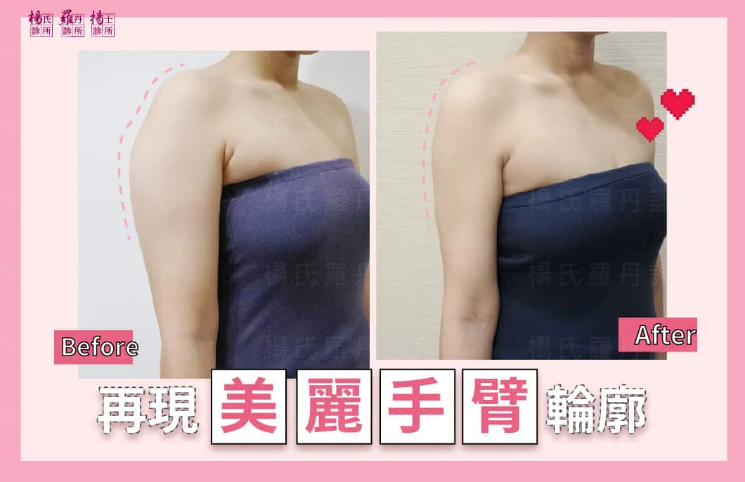 【雷射減脂】再現美麗手臂輪廓!