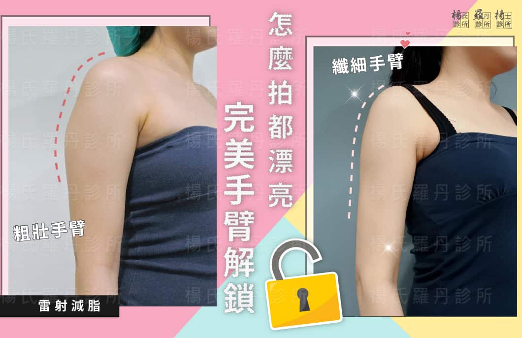 【雷射減脂】完美手臂解鎖，怎麼拍都漂亮！