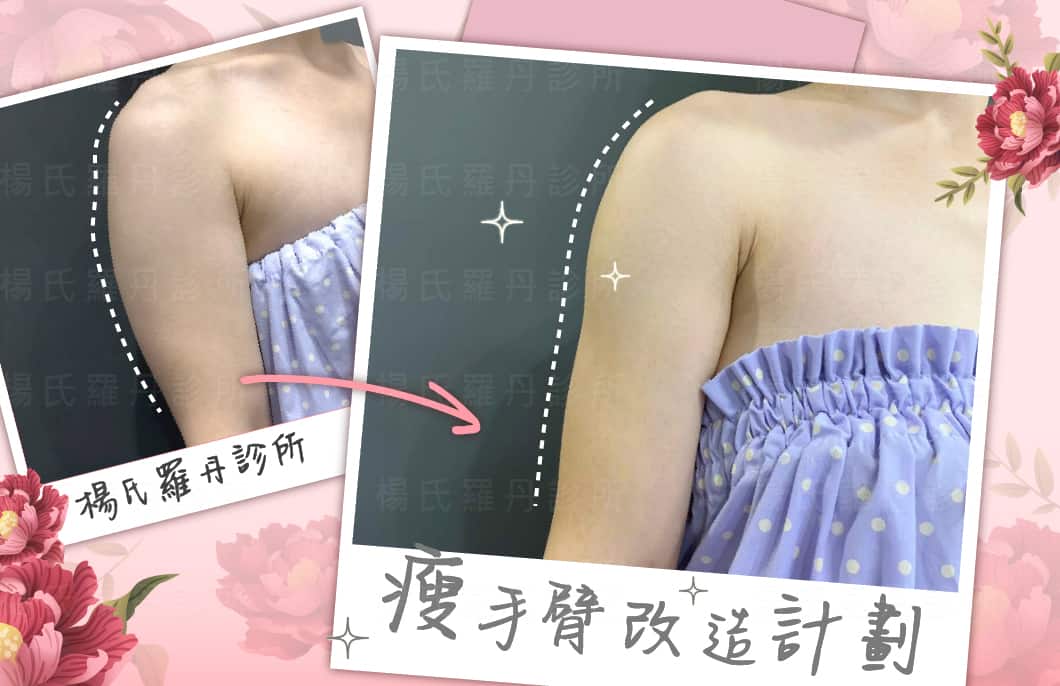 【雷射減脂】瘦手臂改造計劃