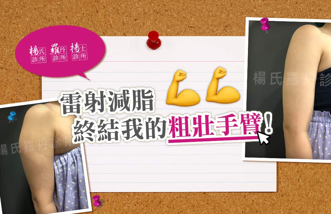 【雷射減脂】雷射減脂，終結我的粗壯手臂！
