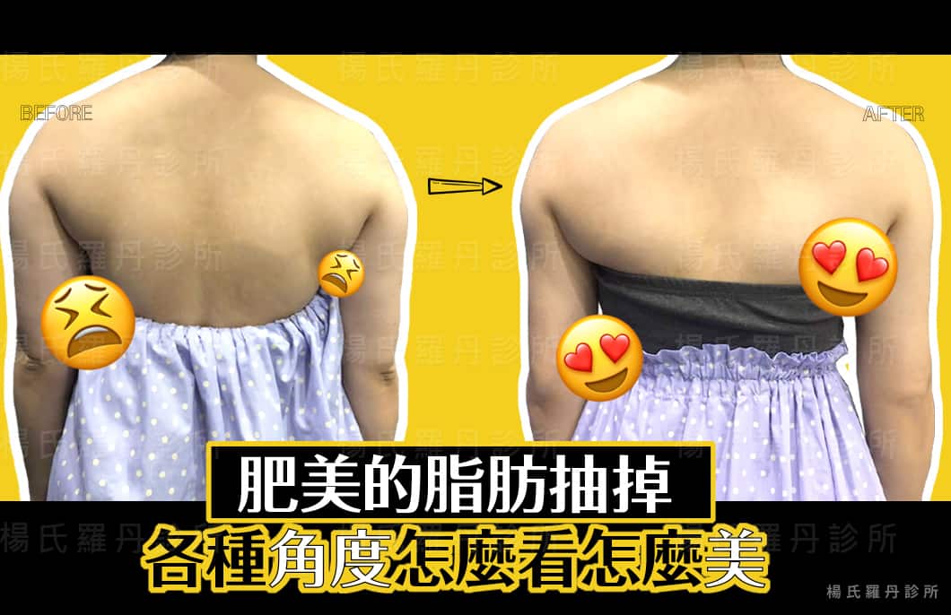 【雷射減脂】肥美的脂肪抽掉，各種角度怎麼看怎麼美!