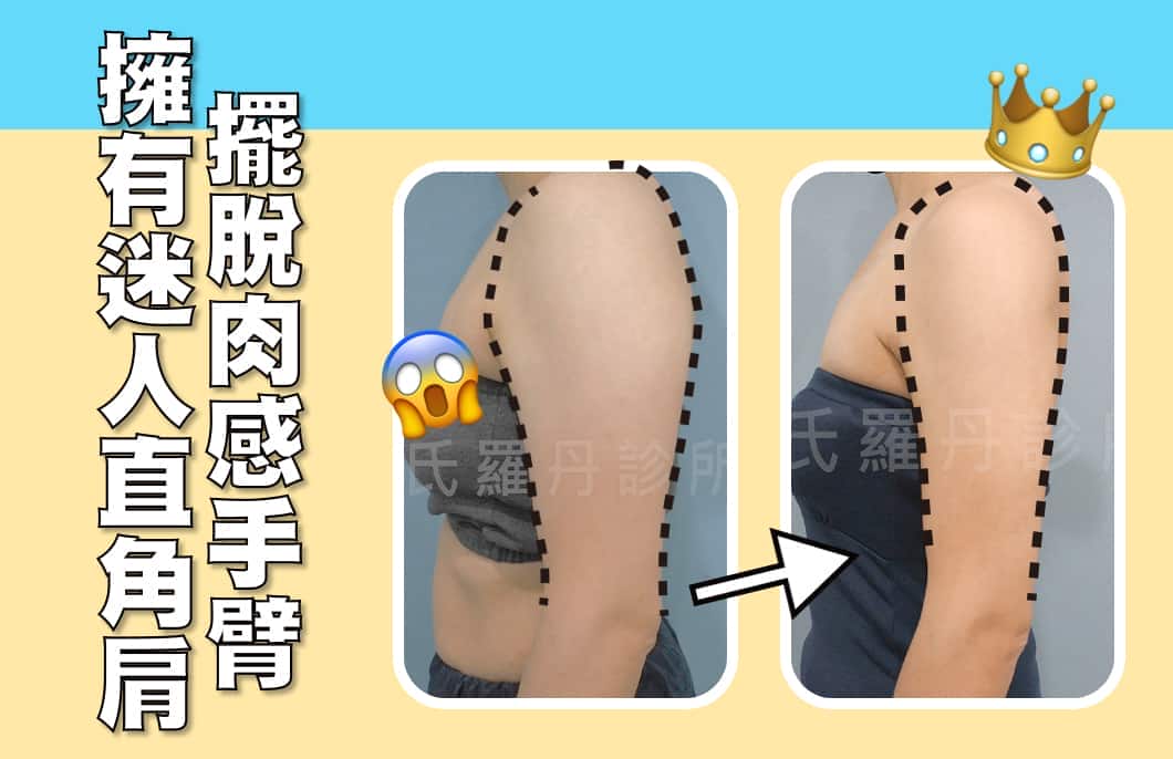 【雷射減脂】擁有迷人直角肩，擺脫肉感手臂