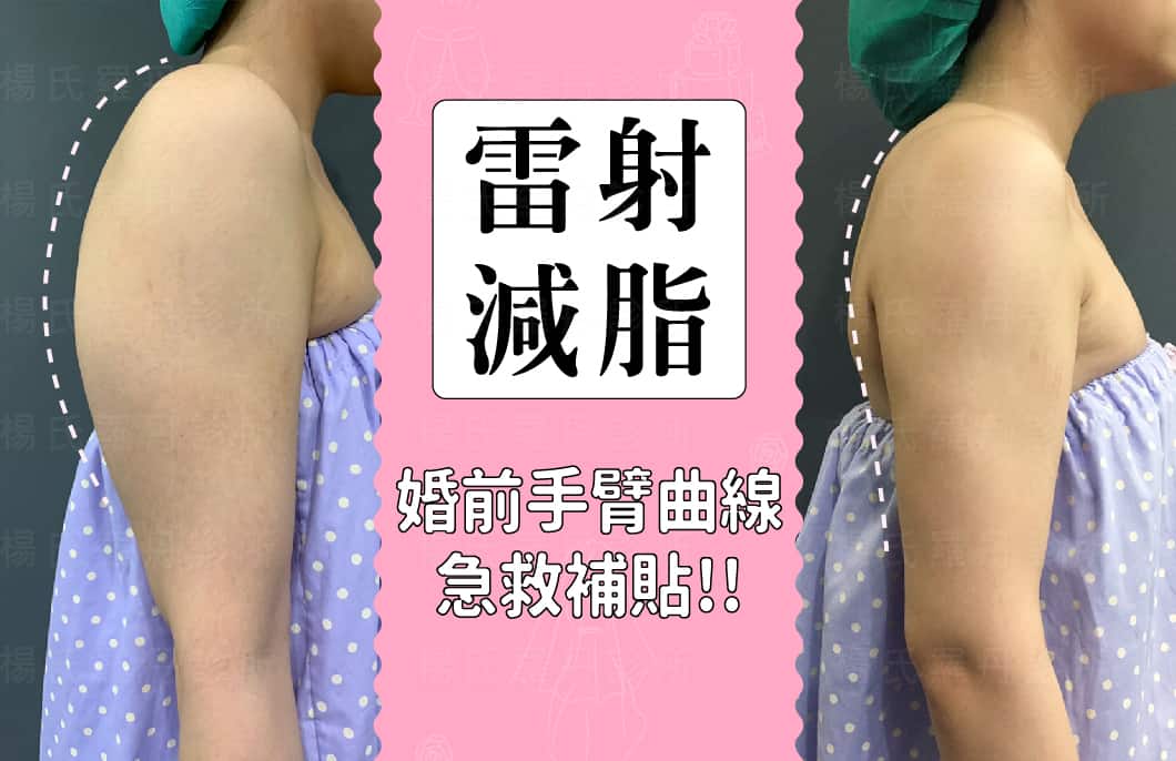 【雷射減脂】婚前手臂曲線急救補貼～