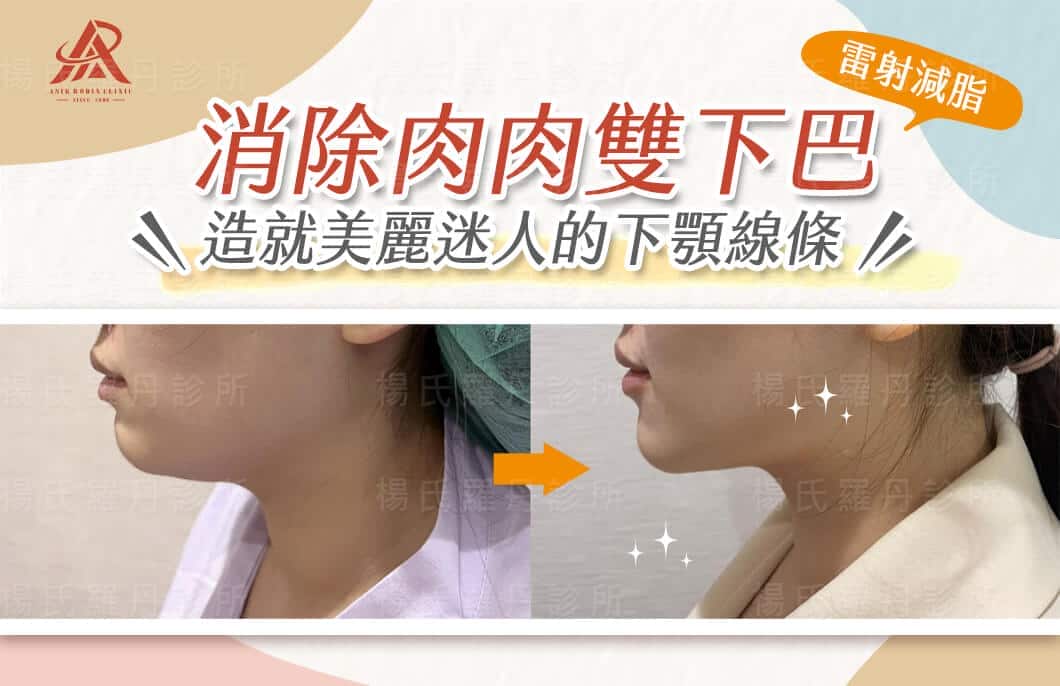 【雷射減脂】消除肉肉雙下巴，造就美麗迷人的下顎線條