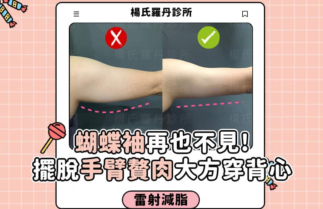 【雷射減脂】蝴蝶袖再也不見!擺脫手臂贅肉大方穿背心