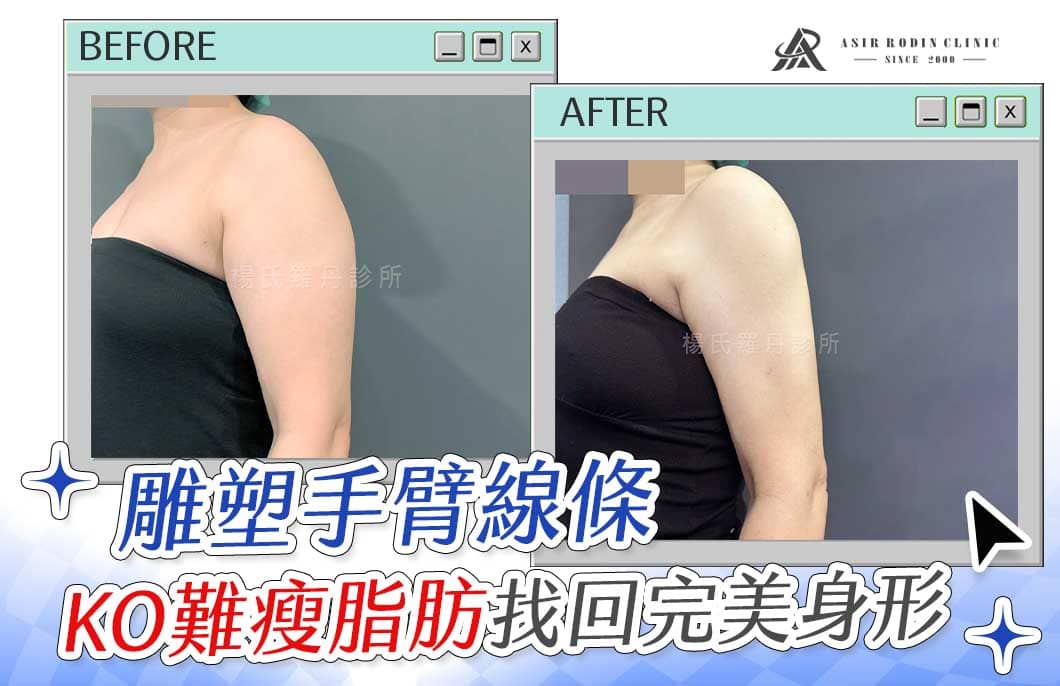 【雷射減脂】雕塑手臂線條，KO難瘦脂肪找回完美身形