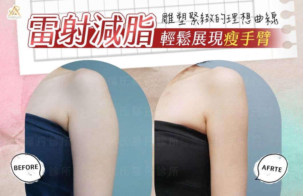 【雷射減脂】輕鬆展現瘦手臂，雕塑自然緊緻的理想曲線
