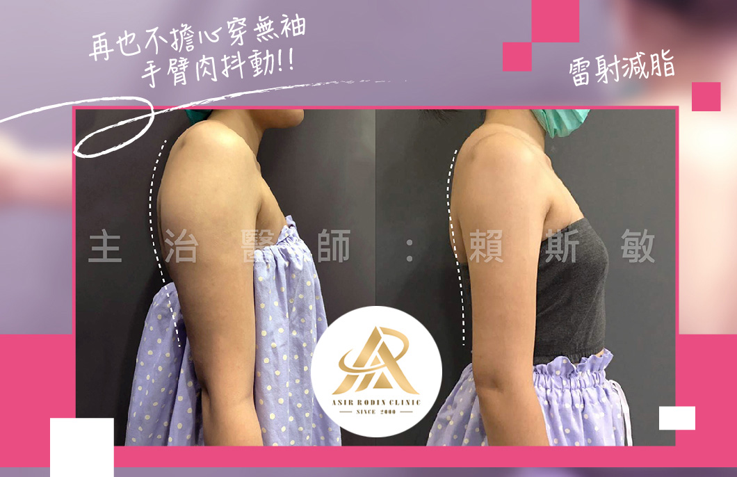 【雷射減脂】再也不擔心穿無袖手臂肉抖動!!