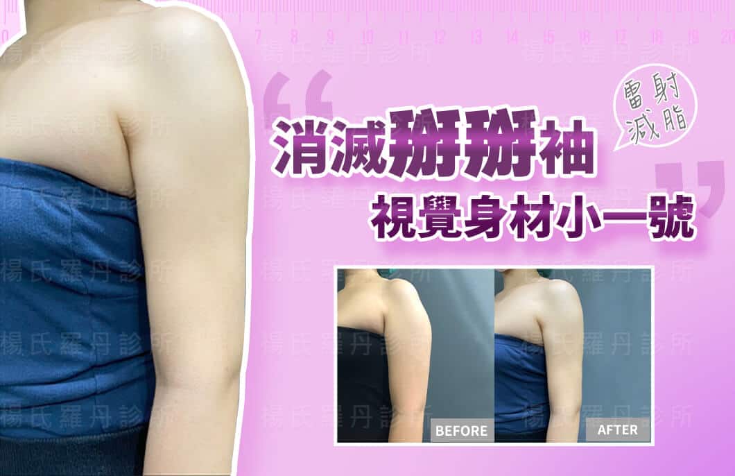 【雷射減脂】消滅掰掰袖，輕鬆瘦手臂實現視覺身材小一號