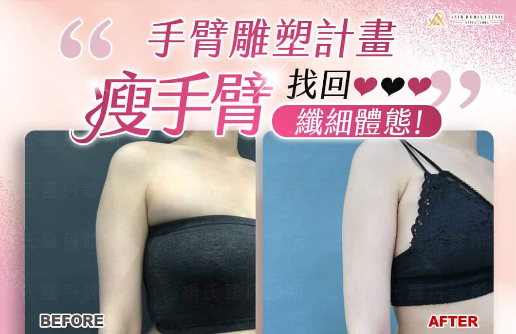 【雷射減脂】手臂雕塑計畫，瘦手臂找回纖細自信體態！