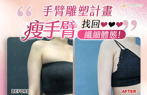 【雷射減脂】手臂雕塑計畫，瘦手臂找回纖細自信體態！
