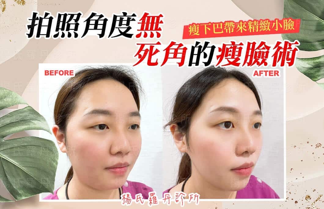 【雷射減脂】拍照角度無死角的瘦臉術，瘦下巴帶來精緻小臉
