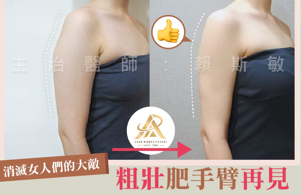【雷射減脂】消滅粗壯脂肪！擁有纖纖手臂不是夢