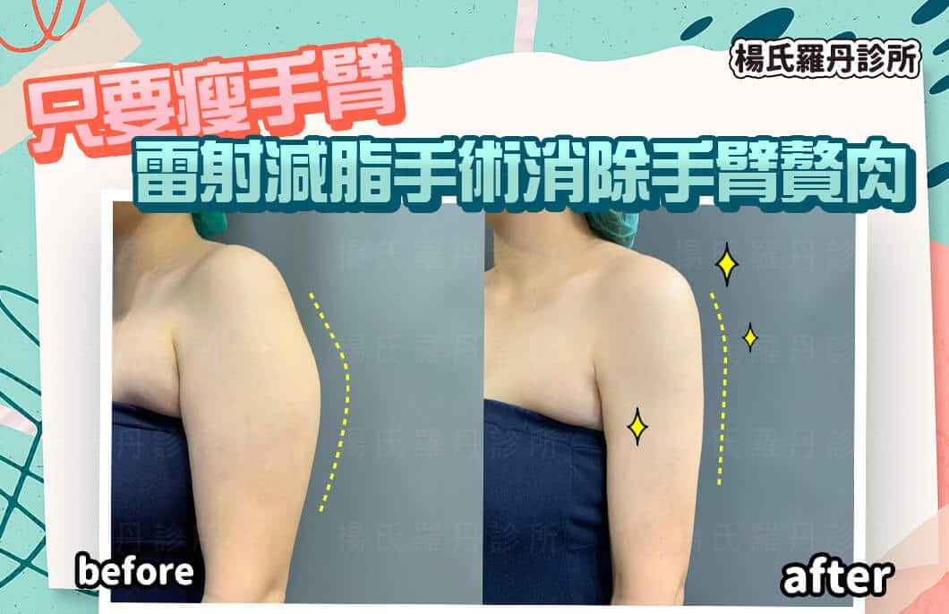 【雷射減脂】只要瘦手臂  雷射減脂手術消除手臂贅肉