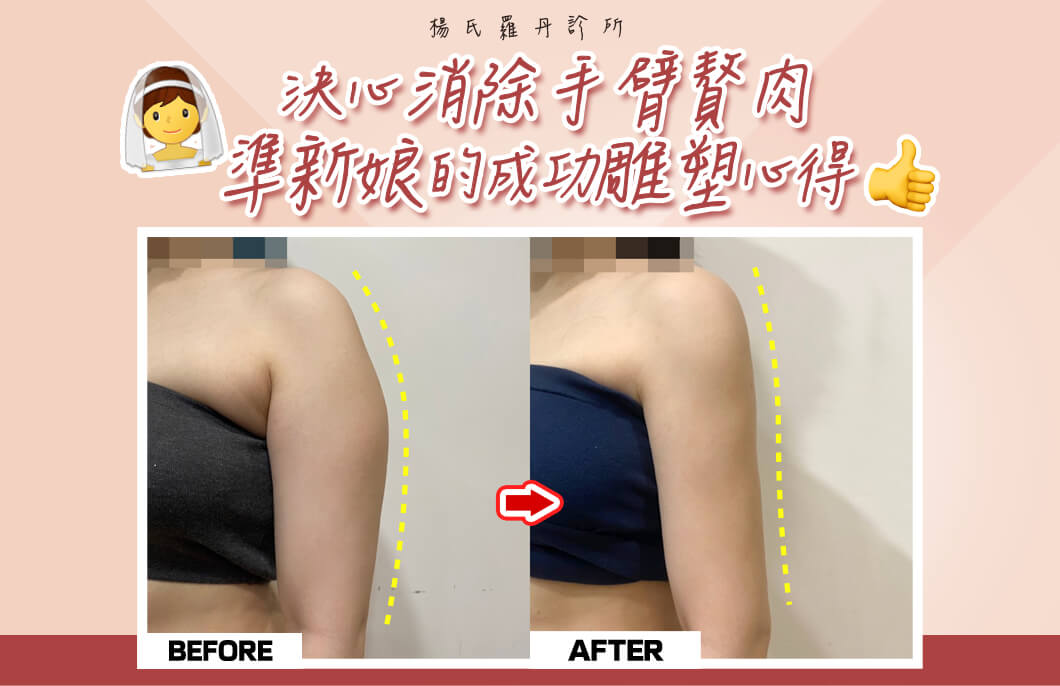 【雷射減脂】決心消除手臂贅肉，準新娘的成功雕塑心得